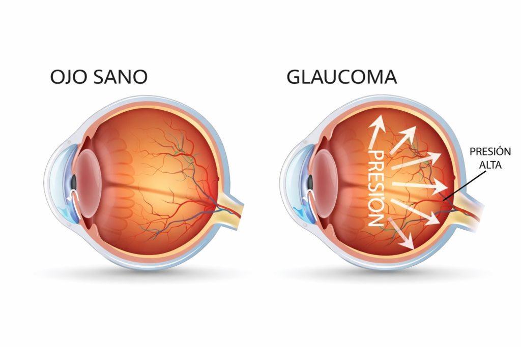 ¡OJO CON EL OJO! SEÑALES DE ALARMA EN ADOLESCENTES glaucoma