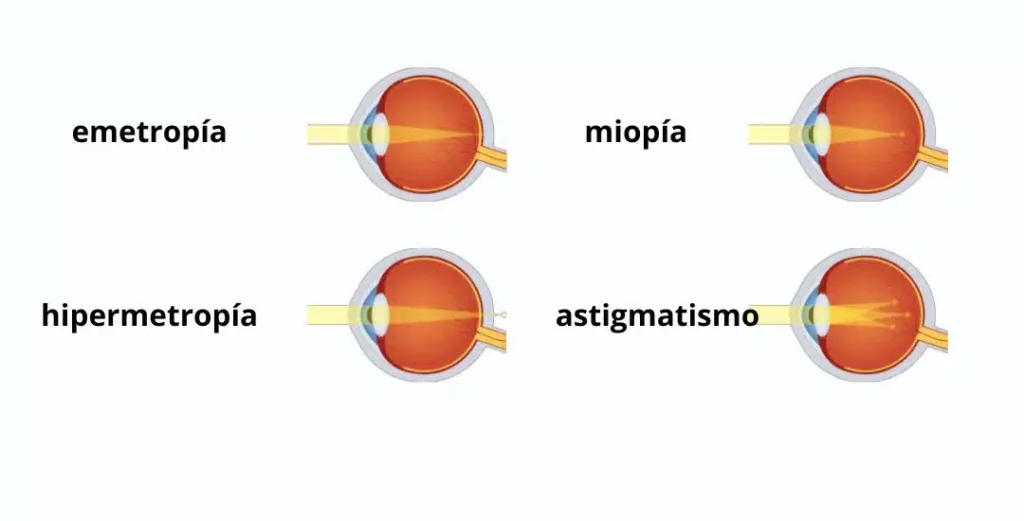 ¡OJO CON EL OJO! SEÑALES DE ALARMA EN ADOLESCENTES emetropia miopia hipermetropia y astigmatismo 1080 × 550 px.jpg